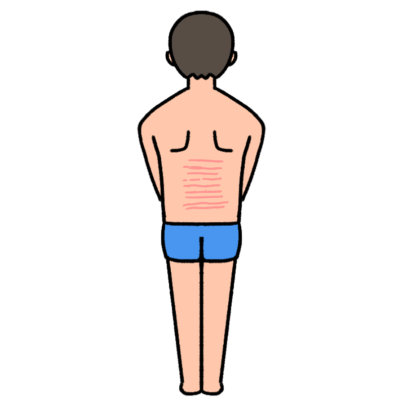 男性の背中の肉割れのイラスト