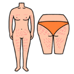 肉割れのイラスト