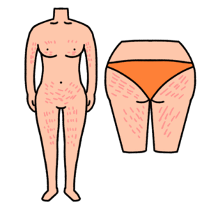 肉割れのイラスト