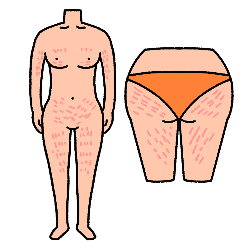 肉割れのイラスト